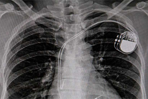 Pacemaker Pacemaker